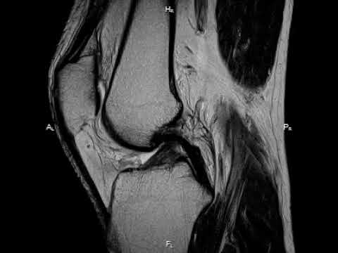 Остеонекроз коленного сустава мрт. Кт снимок коленного сустава. Некроз коленного сустава мрт. Снимки мрт коленного сустава. Крестообразные связки коленного сустава мрт.
