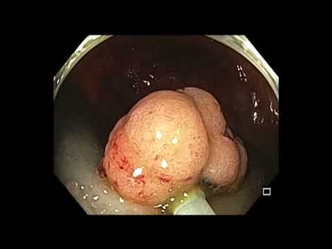 Colonoscopy: Cecal Polyp EMR