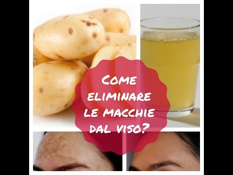 Leliminazione di pigmentary individua su una faccia Cheboksary laser La crema di decolorazione o lunguento