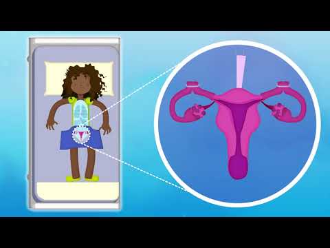 What you need to know about tubal ligation