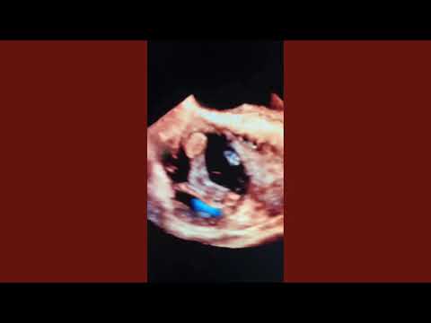 A Large freely mobile RA Thrombus (TEE/3D+Live AngioVac Procedure)