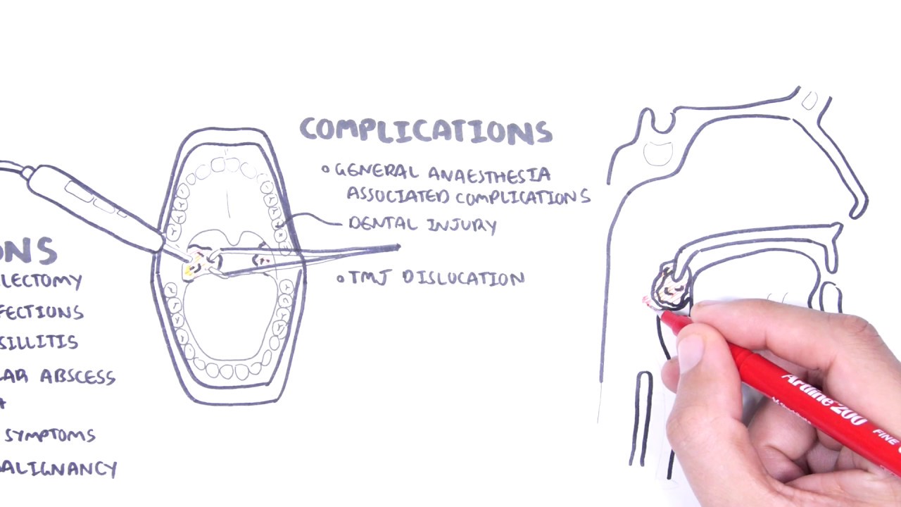 Acute Tonsillitis - causes (viral, bacterial), pathophysiology, treatment, tonsillectomy - YouTube