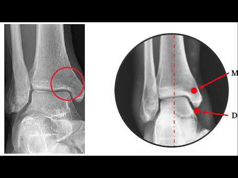 Ankle Fractures: Pathologic changes seen on radiographs