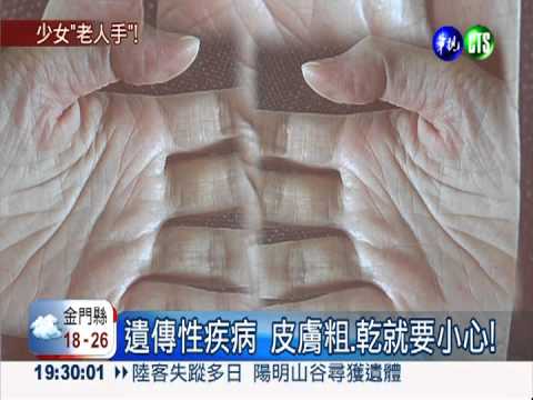 罹尋常魚鱗癬 高中生有"老人手"