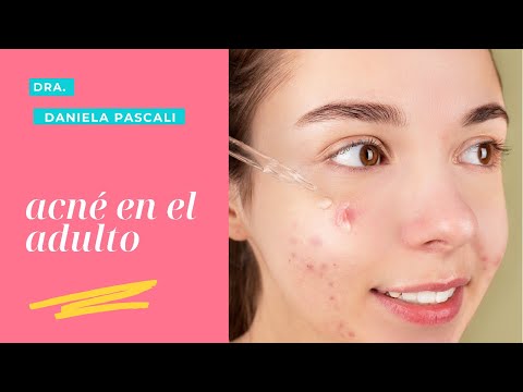 Acne en el adulto