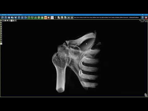 NewTom 7G  - Schulter