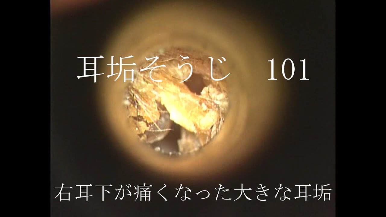 耳垢そうじ/右耳の下が痛くなった大きな耳垢/101