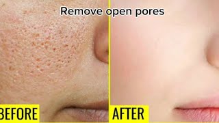 Open pores treatment at home | Remove open pores #openpores #skincare #beautytips #glowingskin