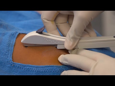 Inserting a One Rod Implant (Health Workers), French - Family Planning Series