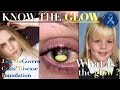 RAISING AWARENESS OF COATS DISEASE  19 YEARS FIGHTING  KNOW THE GLOW
