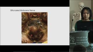 Supernumerary Abducens Nerves - Joy Mu Hsiang Wang, MD, MSc