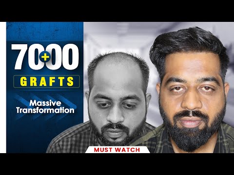 Grade 7 Case Study (7000+ Grafts)