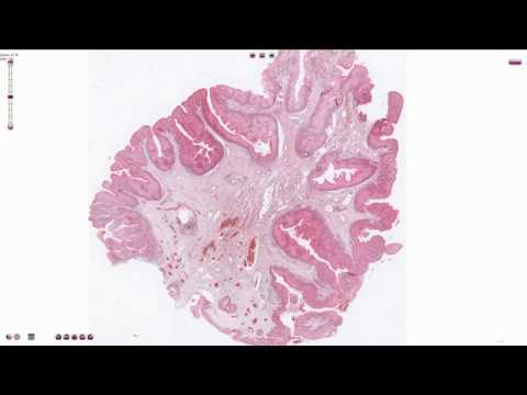 szemölcsök a puha palotán pikkelyes papilloma webpathology