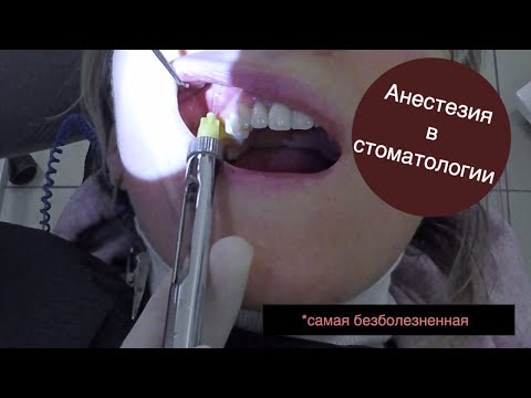 Анестезия в стоматологии. Самая безболезненная инфильрационная анестезия
