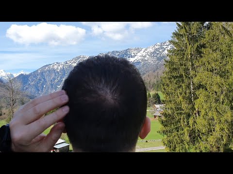 FUE Hair Transplant 10 MONTHS Results | 4050 Grafts
