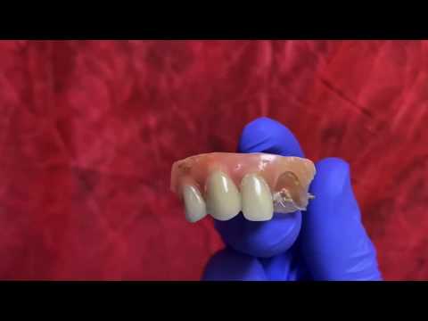How to fix broken denture tooth