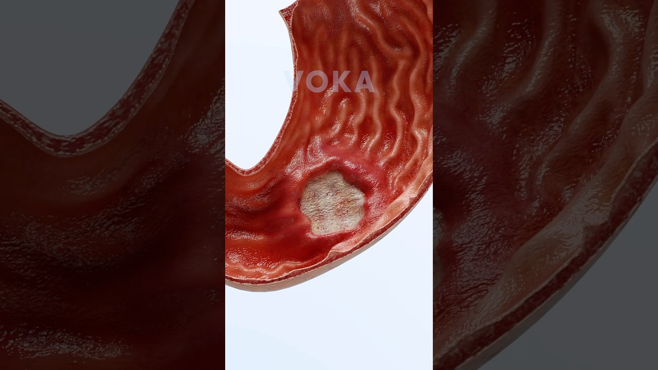 The anatomy of Gastric Ulcers 3D visualization : a 3D exploration of stomach pain with VOKA