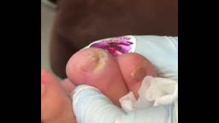 Ep_8176 Foot nails skin removal 👣 ไฮไลท์ไม่ใช่นิ้วโป้ง 😄 (clip from Thailand)