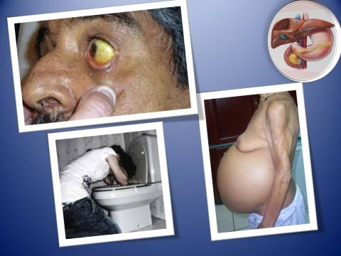 Alcolizzato di marito di consultazione Trattamento di alcolismo in Usolye