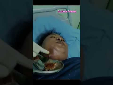 Biggest zit cyst pop ever!