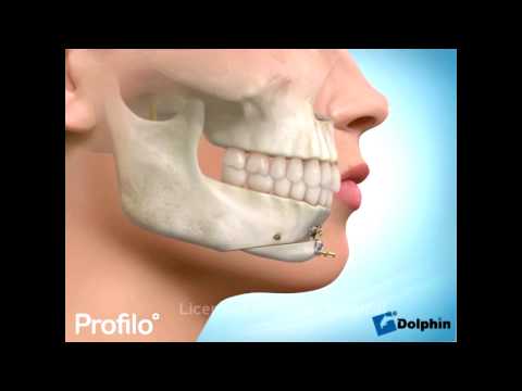 Chin Augmentation Surgery (Genioplasty)