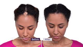 Keranique for Hair Loss and Hair Thinning