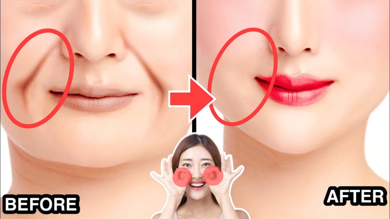 9MINS LAUGH LINES REMOVAL EXERCISE (Nasolabial Folds) | Lift Jowls, Sagging Cheeks