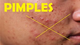 how to get rid of pimples with pus overnight