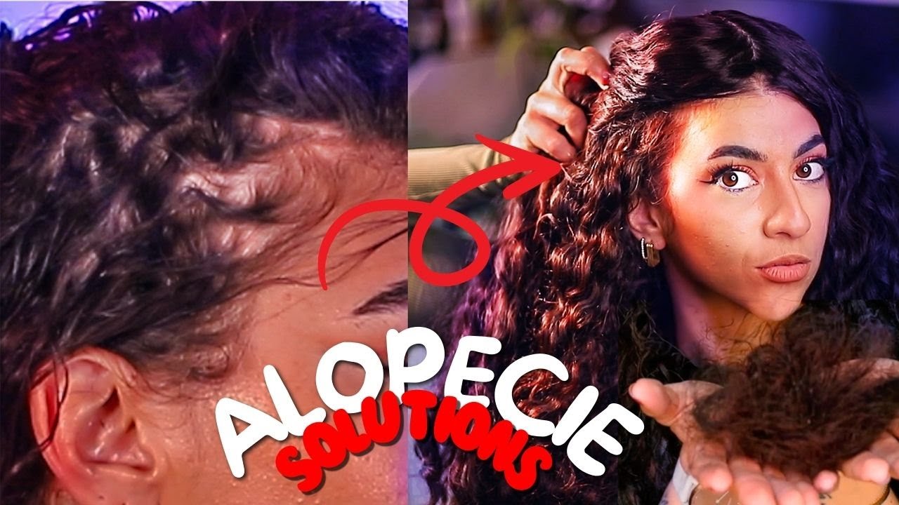 ALOPECIE: LES SOLUTIONS NATURELLES