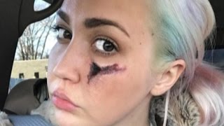 'Voice' Contestant Left With Hole In Face From Venomous Spider Bite