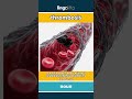 thrombosis - a health problem where a lump... video thumbnail