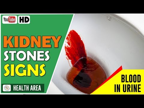 8 Kidney Stone Signs and Symptoms Video