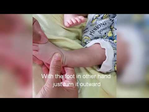 Maternal manipulation for clubfoot/CTEV
