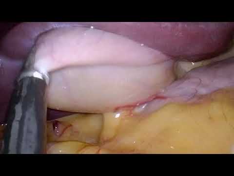 Cholecystectomie laparoendoscopique sous anesthésie péridurale