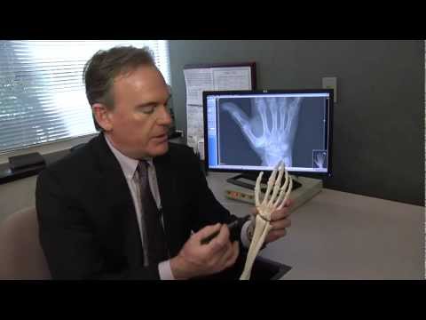 Treating Basal Thumb Joint Arthritis - Mayo Clinic