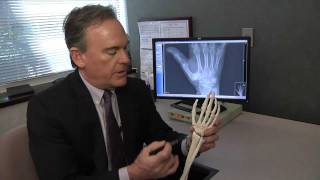 Treating Basal Thumb Joint Arthritis - Mayo Clinic