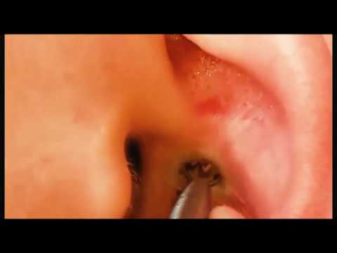 Давим прыщи! Черные точки в ушах, черные точки на лице!