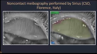 Non contact Meibography in ocular surface disorders