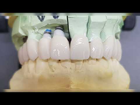 Zolid Gen-x Full Contour Zirconia Crowns