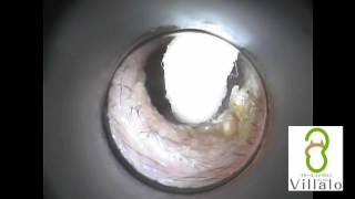 耳掃除動画vol.3「1か月ためた耳垢」