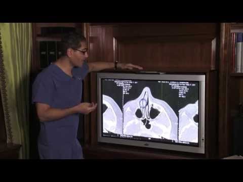 Dr. Sam Rizk Repairs Deviated Septum