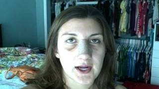My New Nose…Again! VJournal: Post-Op Day 9