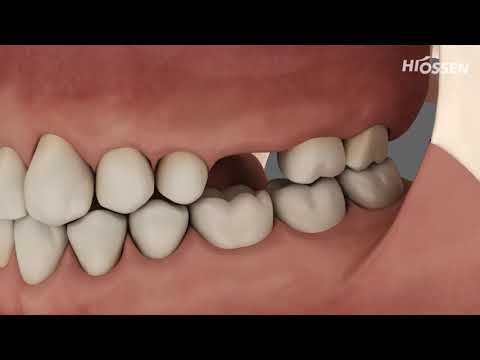 CAS KIT: Crestal Approach - Sinus KIT (Single Case)