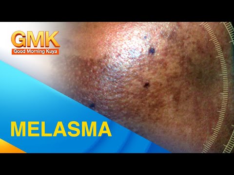 MELASMA: Cause and Treatment Explained by Dermatologist