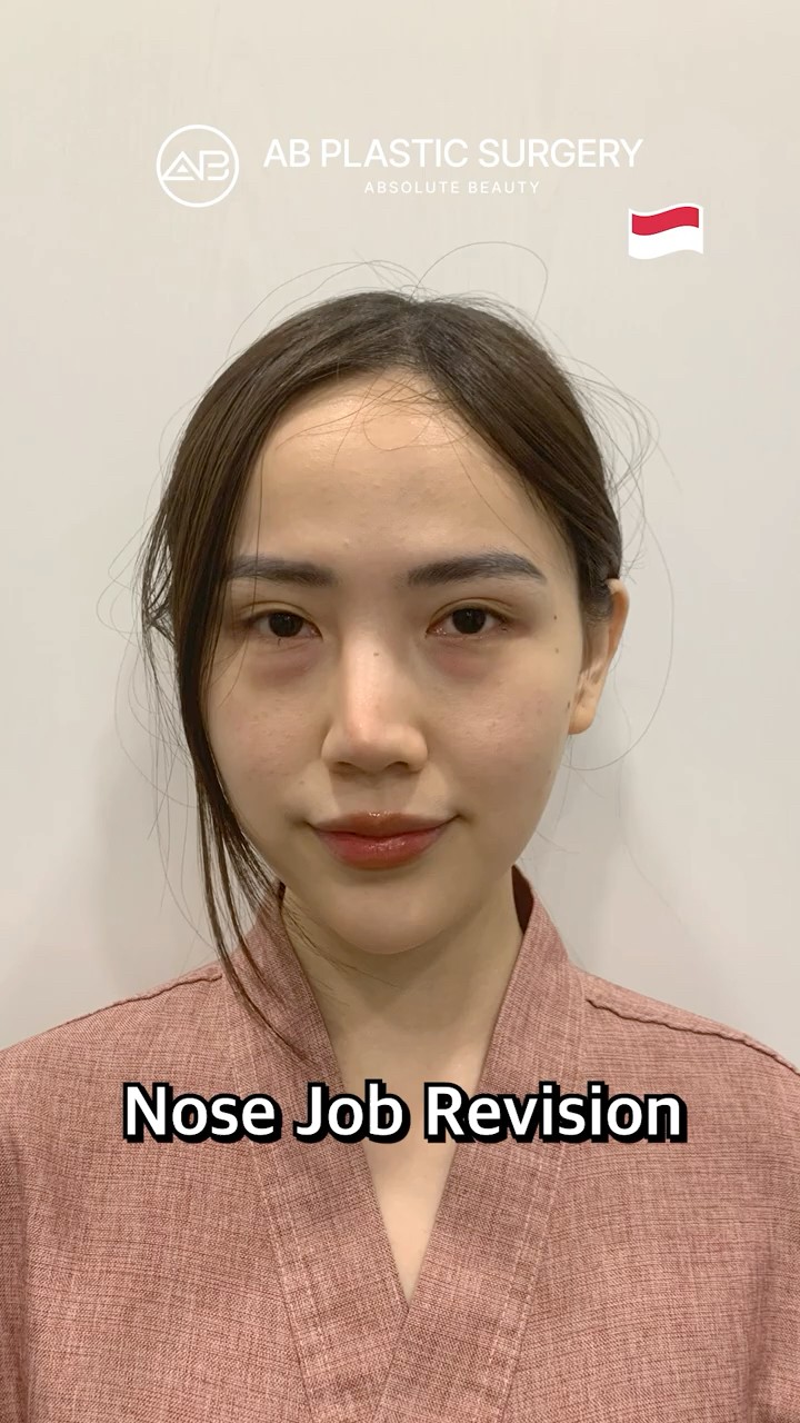 Glow Up with Rhinoplasty & Eyelid Surgery!
