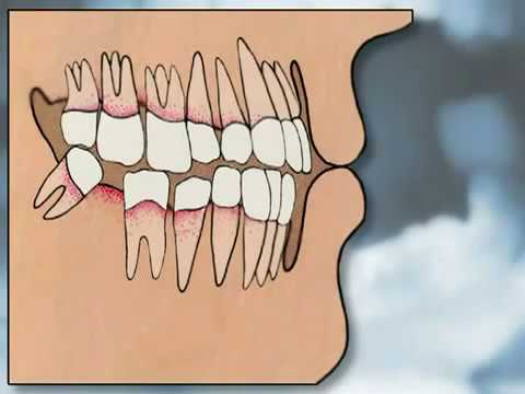 Plastic surgery sa kanyang dibdib sa Rostov on Don Kung magkano ang timbang sa isang dibdib ipunla