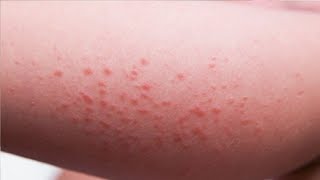 how to get rid of a skin rashes that itch