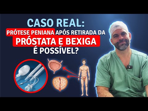 Real case: Is penile prosthesis possible after prostate and bladder removal? | Dr. Marco Túlio