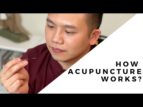 What is Acupuncture? And does it Work?