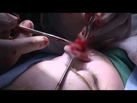 download lagu mp3 mp4 Rhinoplasty Utah, download lagu Rhinoplasty Utah gratis, unduh video klip Rhinoplasty Utah